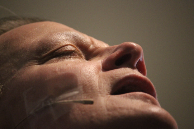 Nahaufnahme eines Frauengesichts während einer Gesichtsstraffungsoperation, mit mehreren Nadeln in der Nase und geschlossenen Augen.